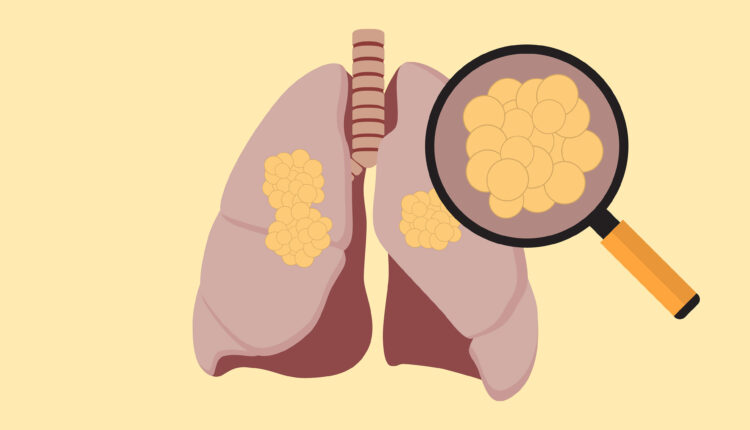 An illustration shows a diagram of lungs with a magnifying glass over cancer cells inside of them.