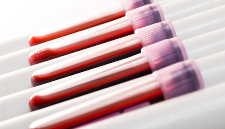 A photo of blood samples in vials.